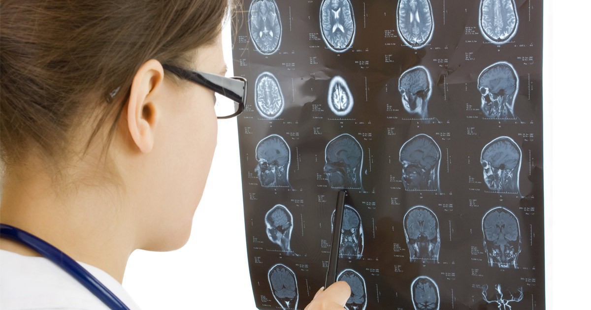 What Are Signs of a Car Accident Brain Injury?