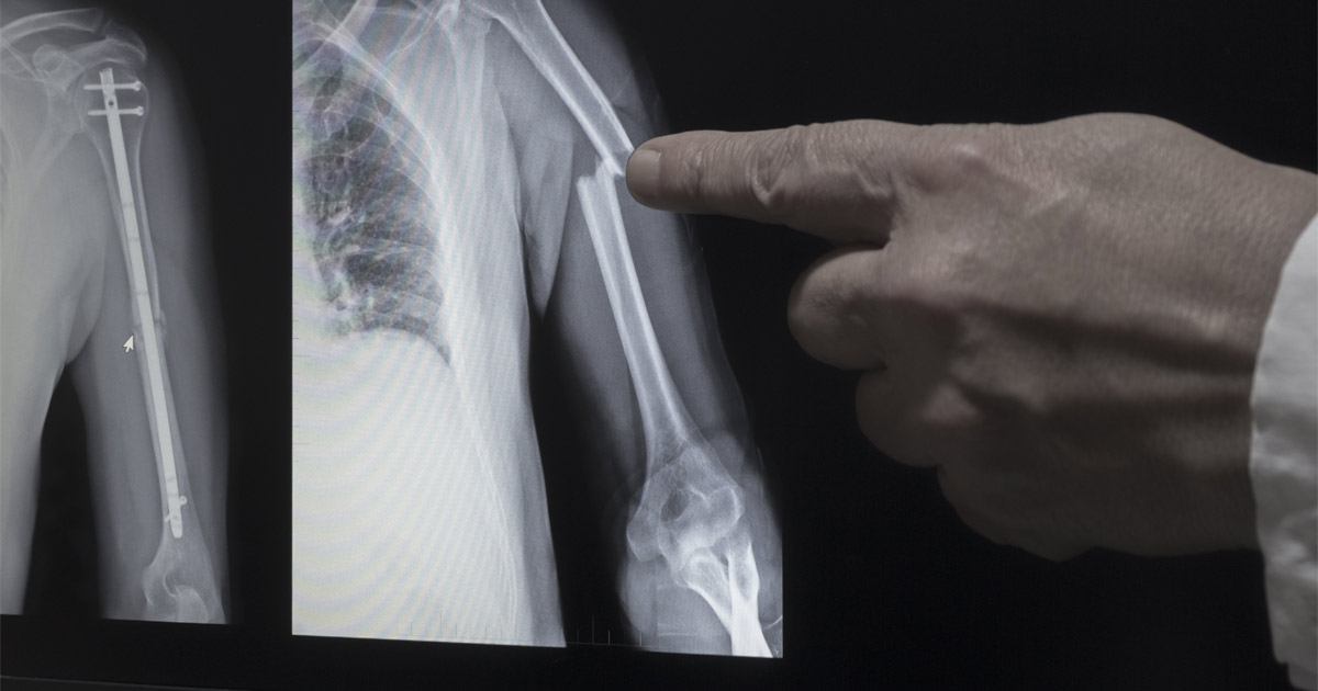 How Much Is a Broken Bone Injury Case Worth?