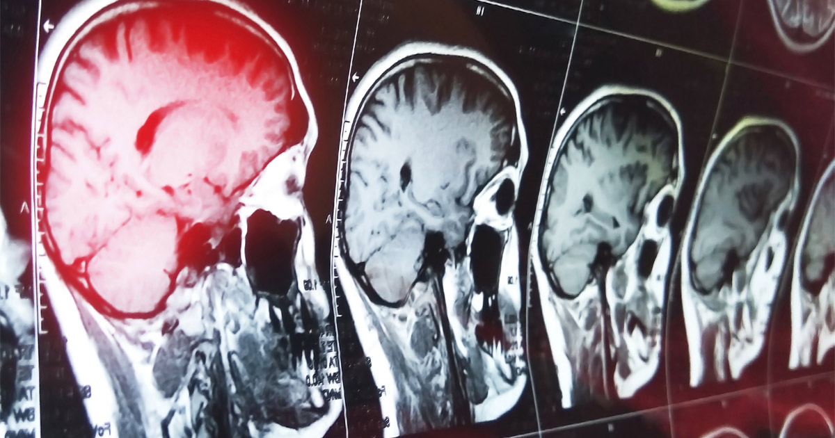 Can a Car Accident Cause Traumatic Brain Injuries?